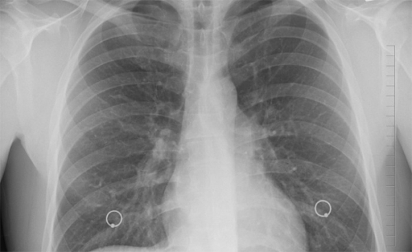 Plicní lékaři odhalili v Ústeckém kraji 4 nemocné